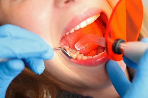 Dental Bonding in Danforth