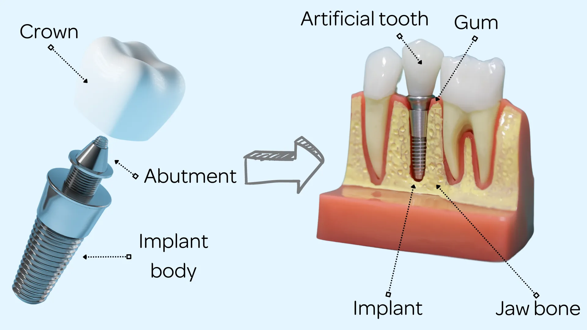 A Complete Guide to Dental Implants in Pape dental