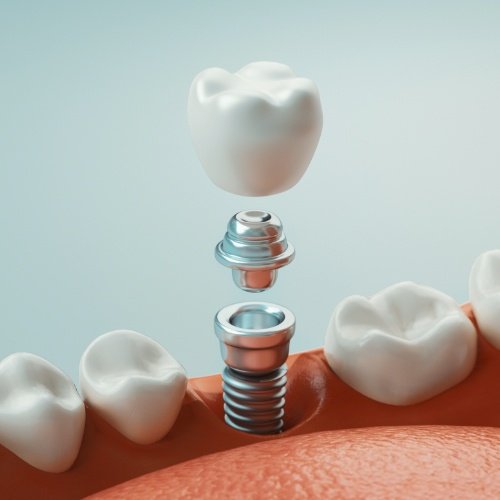 What Are the Costs of Dental Implants at Pape Dental Centre?