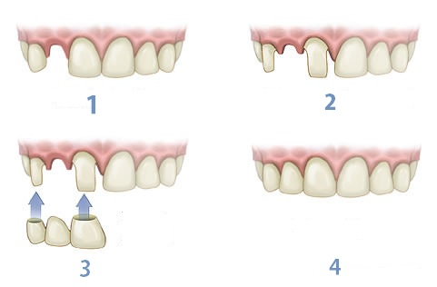 Step-by-Step Process for Getting Dental Bridges in Danforth