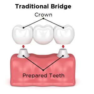 Traditional Dental Bridges