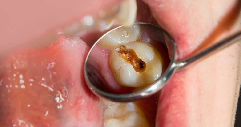 Close-up of the inside of a mouth showing a tooth decay reflected in a dental mini mirror