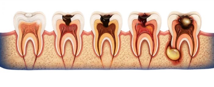 Vector illustration showing the stages of tooth decay and its progression