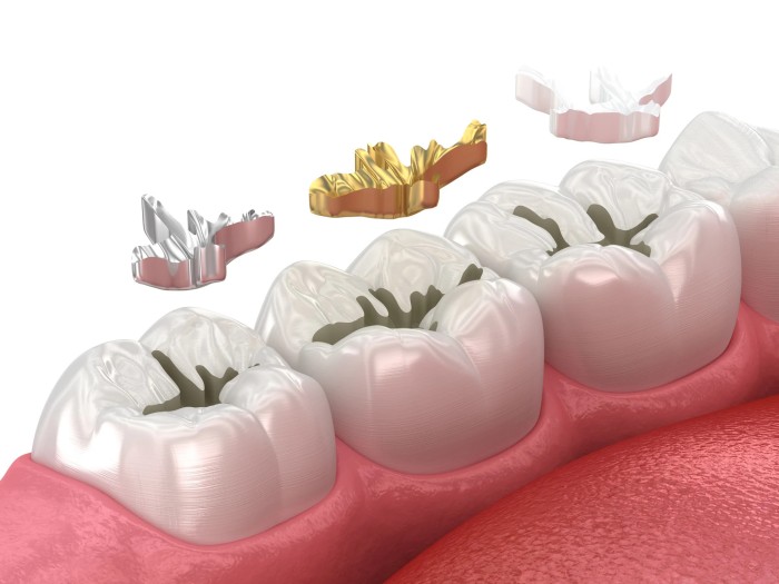 Vector illustration of dental fillings and different types of filling materials