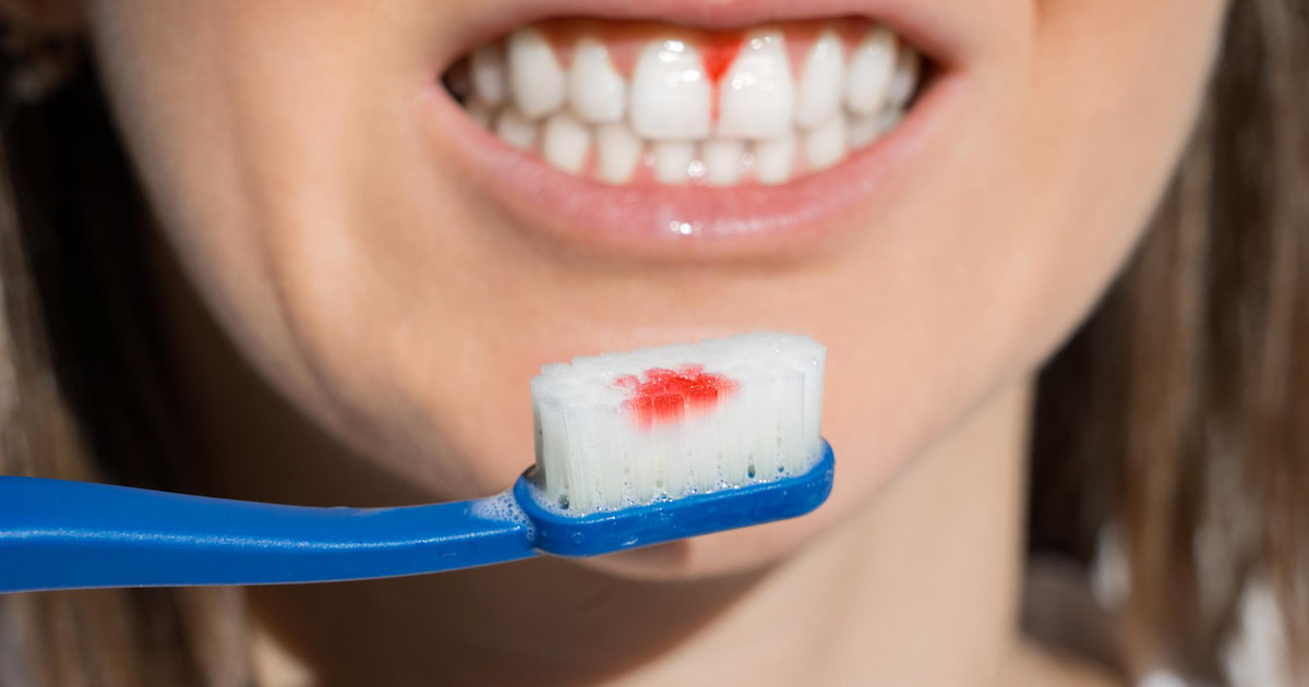 Gingivitis: Causes, Symptoms, and Effective Treatments