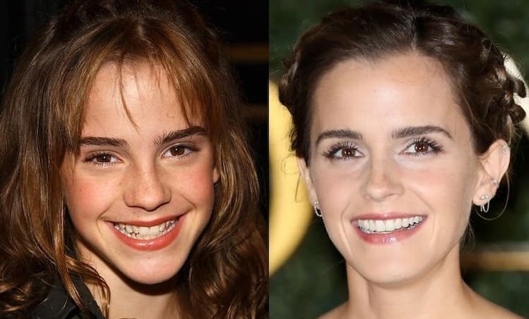 Emma Watson before after
