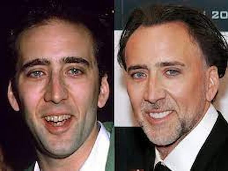 Nicolas Cage before after