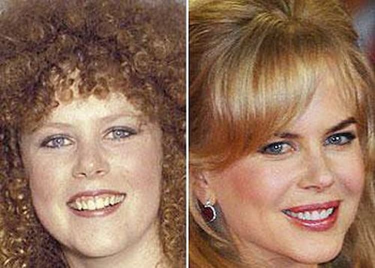 Nicole Kidman before after
