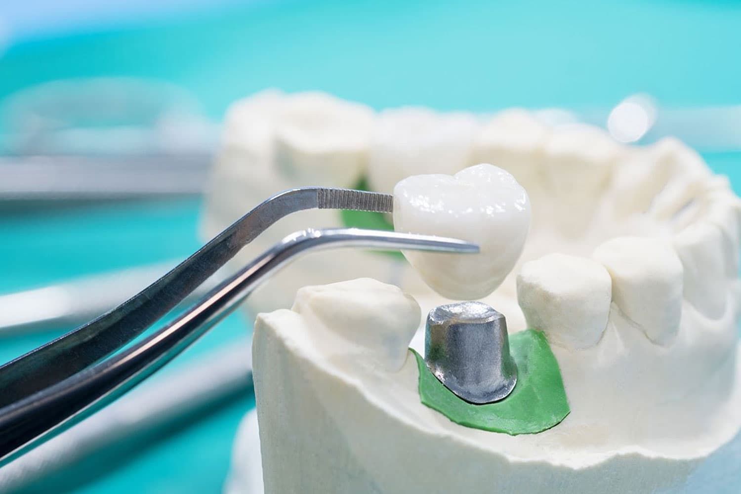 For lost fillings or crowns, try: