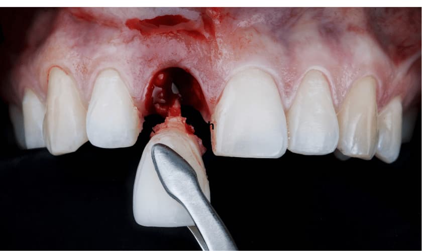 Tooth Extraction