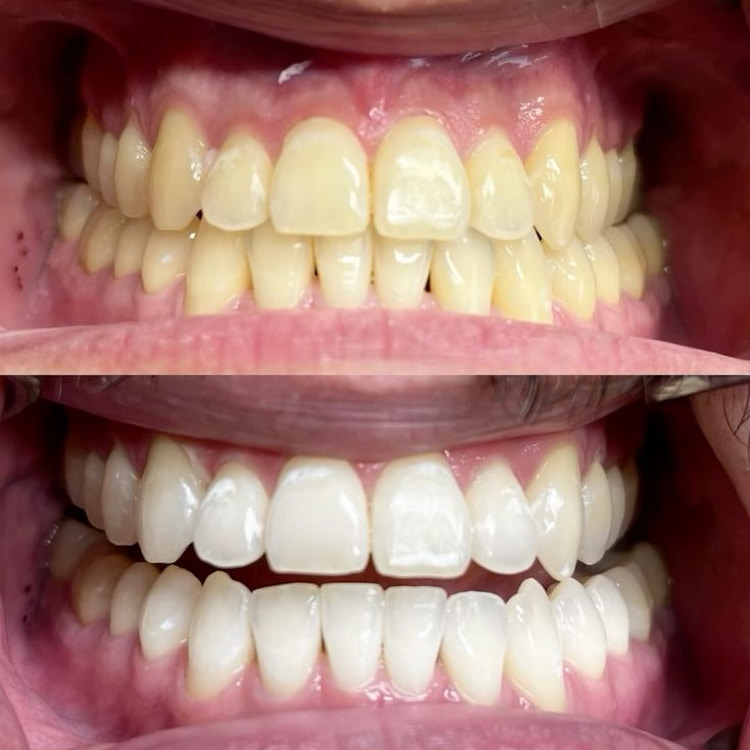 Before and after teeth whitening treatment
