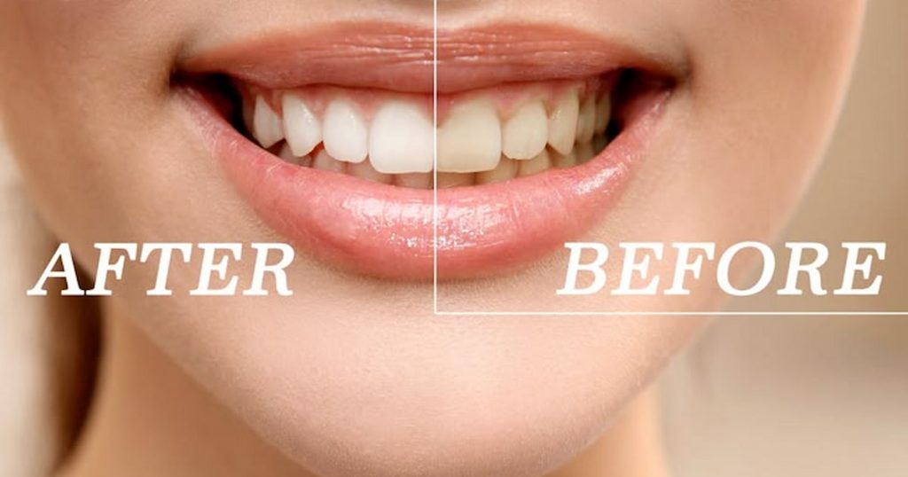Teeth Whitening Results: How Long Do They Last and How to Maintain Them