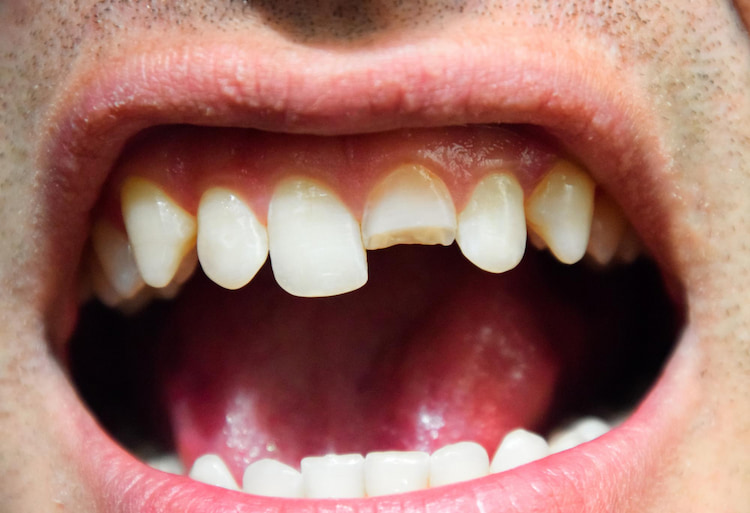 cracked or chipped teeth as one of common dental problems