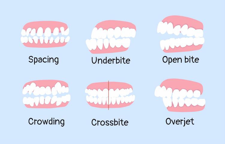types of malocclusion