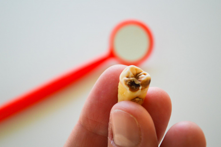 a hand holding a tooth with cavities