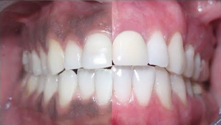 Black Gums Causes