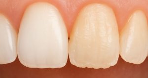 Tooth Enamel Erosion: Causes, Symptoms, and Treatment