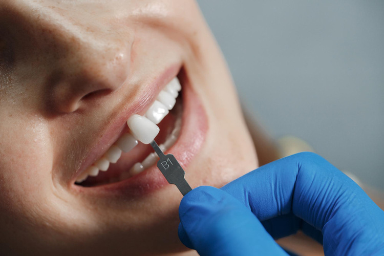 dental bonding for treating white spots on teeth