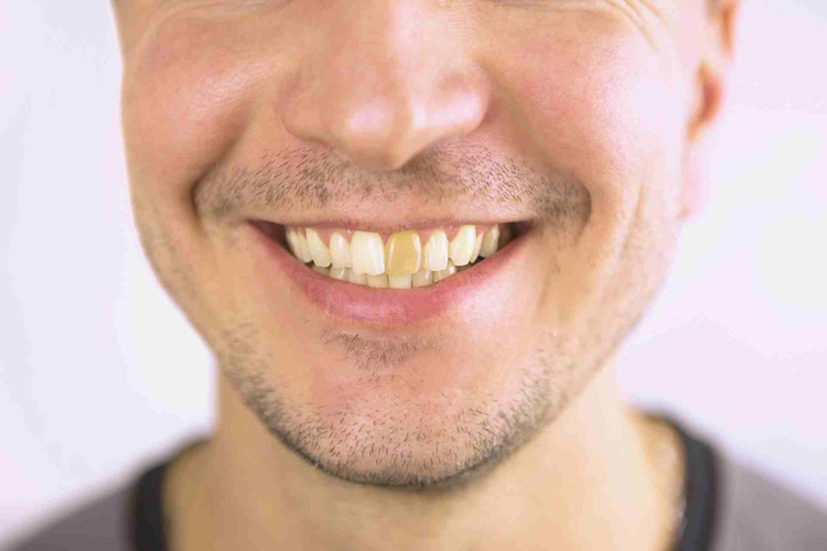 dead tooth symptoms: discoloration