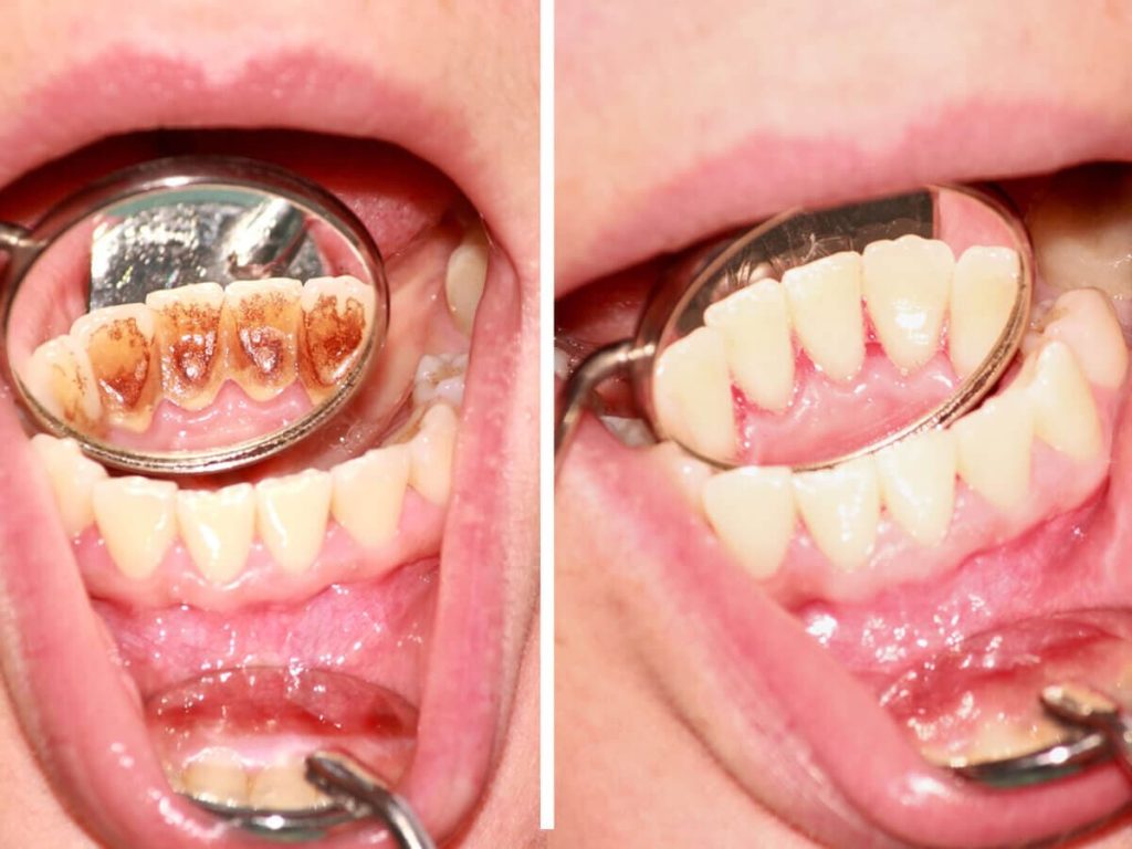 Dental Scaling vs. Deep Cleaning