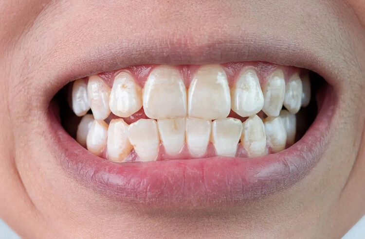 Enamel Hypoplasia and white spots on teeth