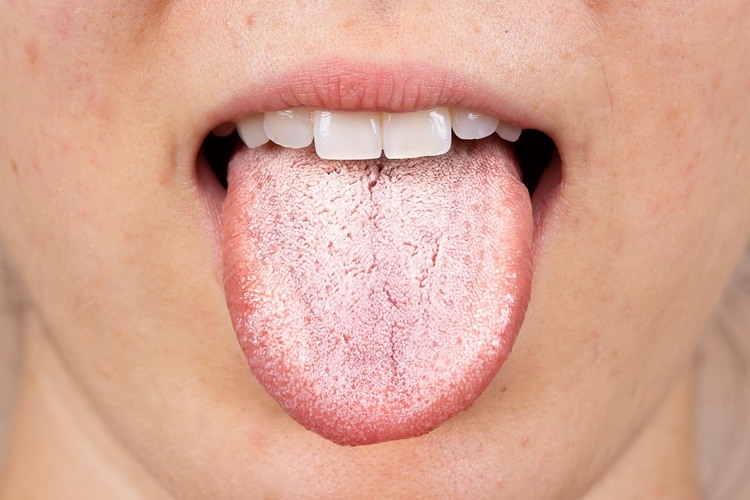 Close-up view of oral thrush symptoms showing white patches and redness on the tongue
