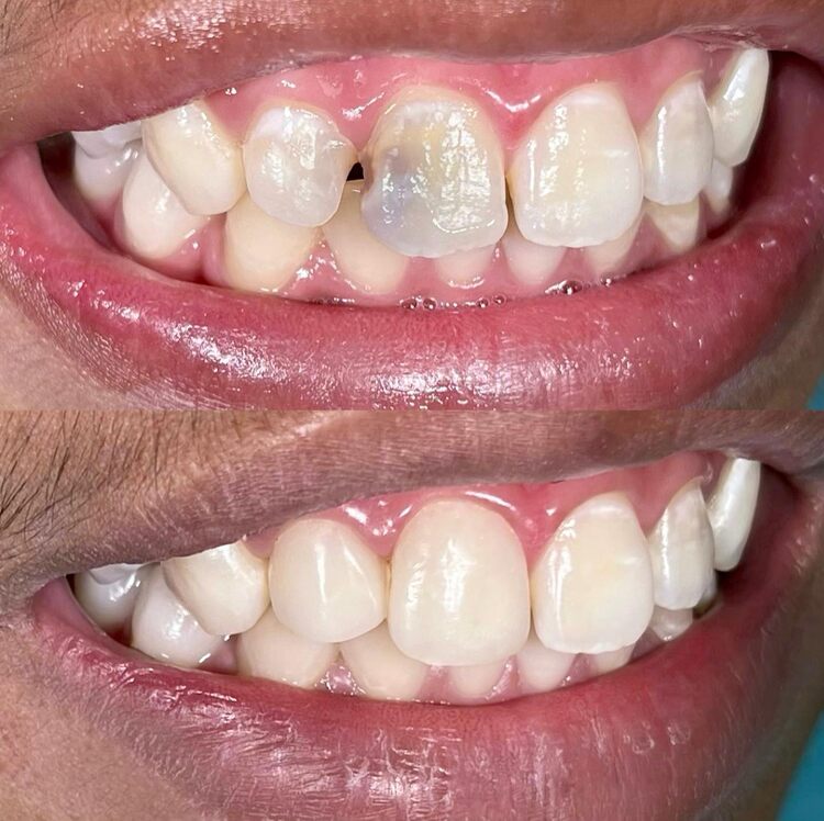 root canal before and after results