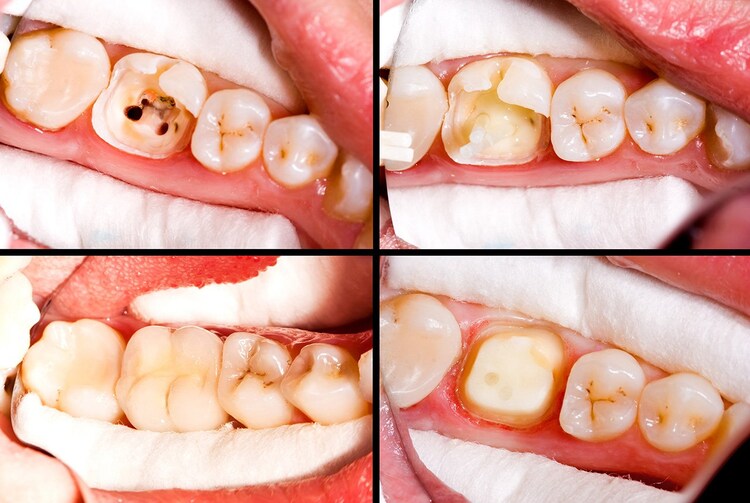 the result of root canal before and after images