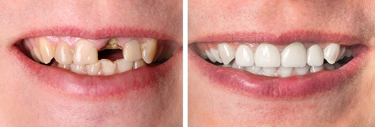 root canal before and after images