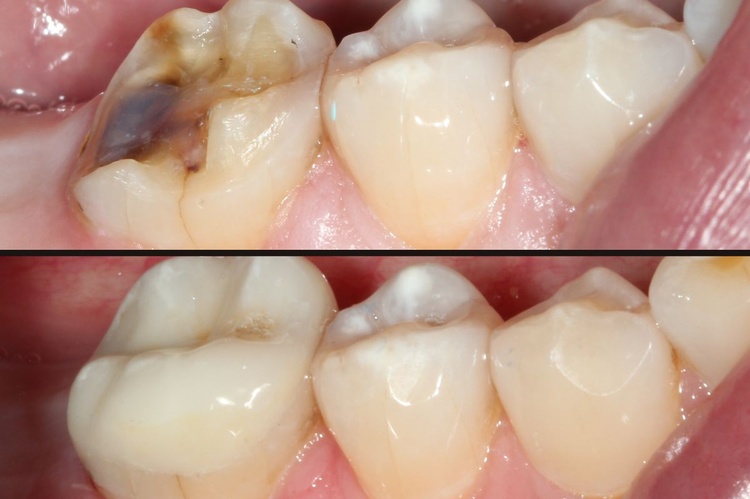 before and after root canal images 