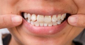 white spots on teeth