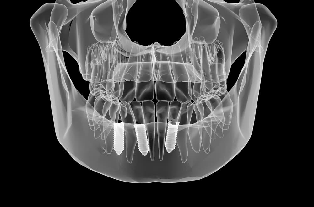 3D Dental Imaging (X-Rays)