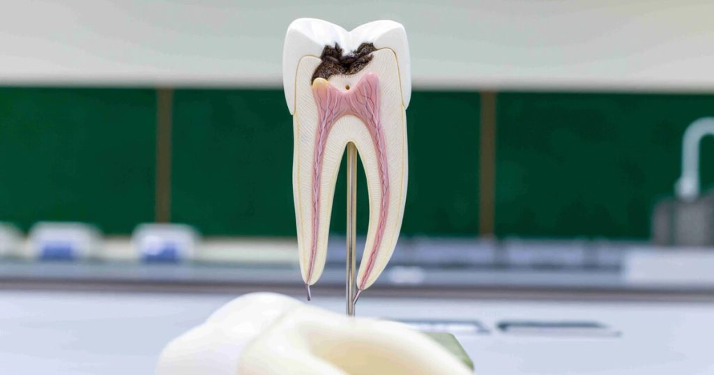 Dead Tooth Root Canal Before and After