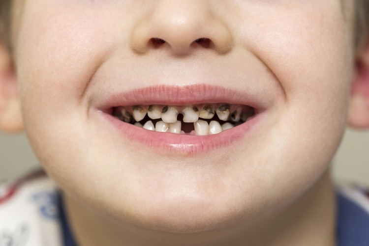 Close-up of a child's teeth showing visible decay and signs of rotten teeth.