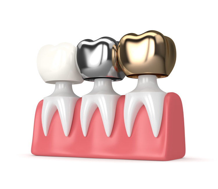 Vector illustration showing different types of dental crown materials
