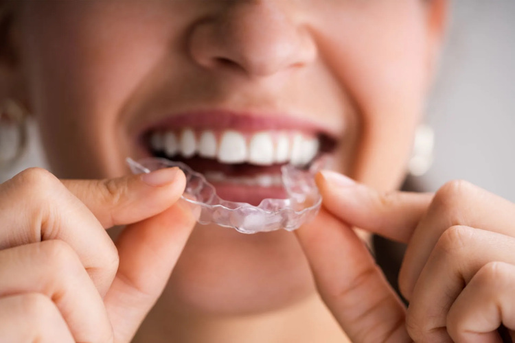 Close-up of a woman holding a night guard in front of her mouth, smiling, to protect and extend the life of her dental crowns.