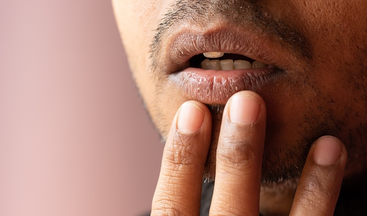 Close-up of a man’s mouth with dry, chapped lips showing symptoms of dry mouth (xerostomia)