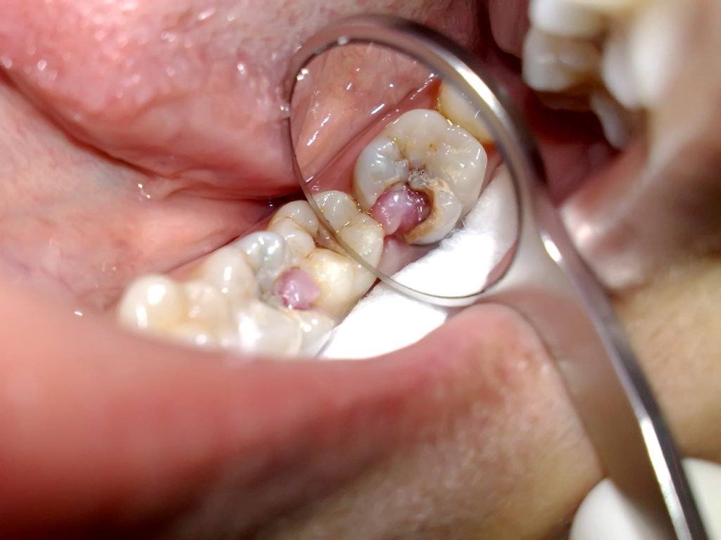 an image of dental pulpitis