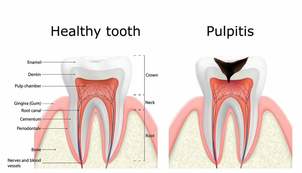healthy tooth vs. pulpitis