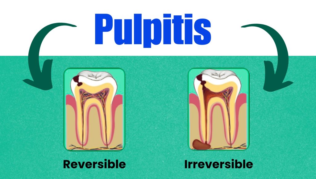 reversible and irreversible pulpitis treatment