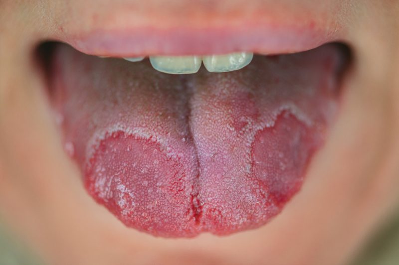 red spots on the tongue: geographic tongue