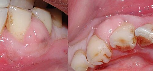 A periodontal gum abscess