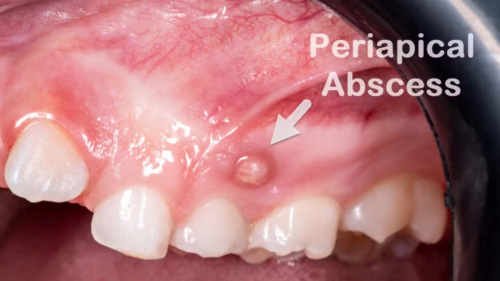 Periapical Gum Abscess