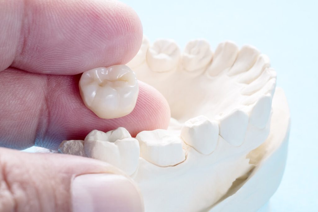 indirect dental restorations: dental crowns