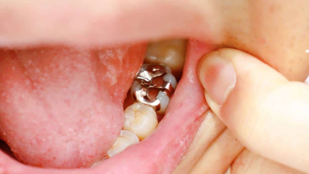 direct dental restorations: dental fillings