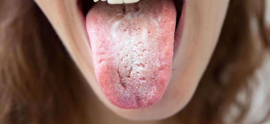 red spots on the tongue: oral thrush