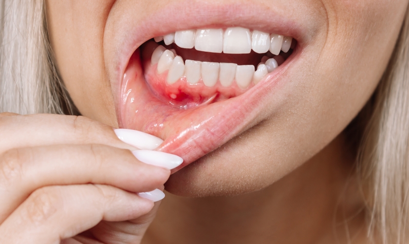 Gum abscess causes, symptoms, pictures, treatment