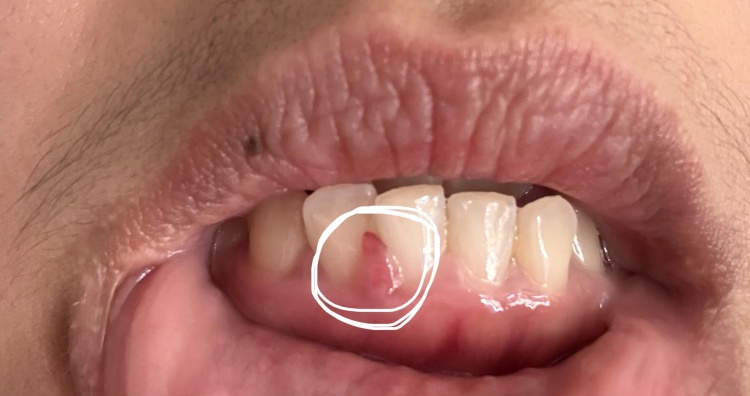Close-up of a man's teeth showing a loose gum flap between teeth in the interdental area with signs of gum irritation.