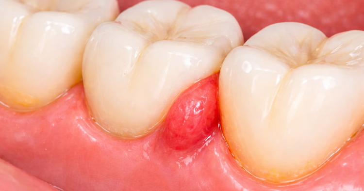 Close-up of two adjacent teeth showing a loose gum flap between them in the interdental papilla area, indicating gum tissue detachment.