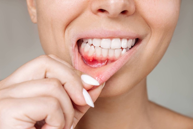Close-up of a woman with her mouth open showing visible teeth and inflamed, swollen gums consistent with gum disease.